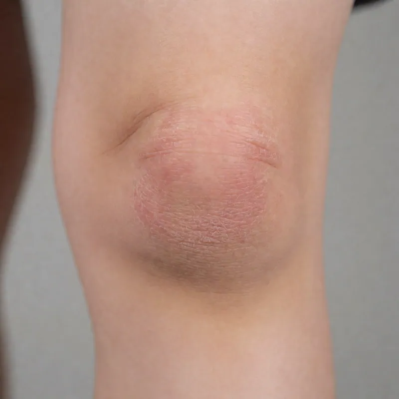 Illustrative image of childhood eczema — a generated illustration of a typical presentation, not a photograph of a patient