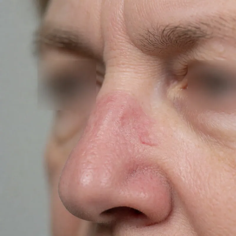 Illustrative image of seborrheic dermatitis — a generated illustration of a typical presentation, not a photograph of a patient
