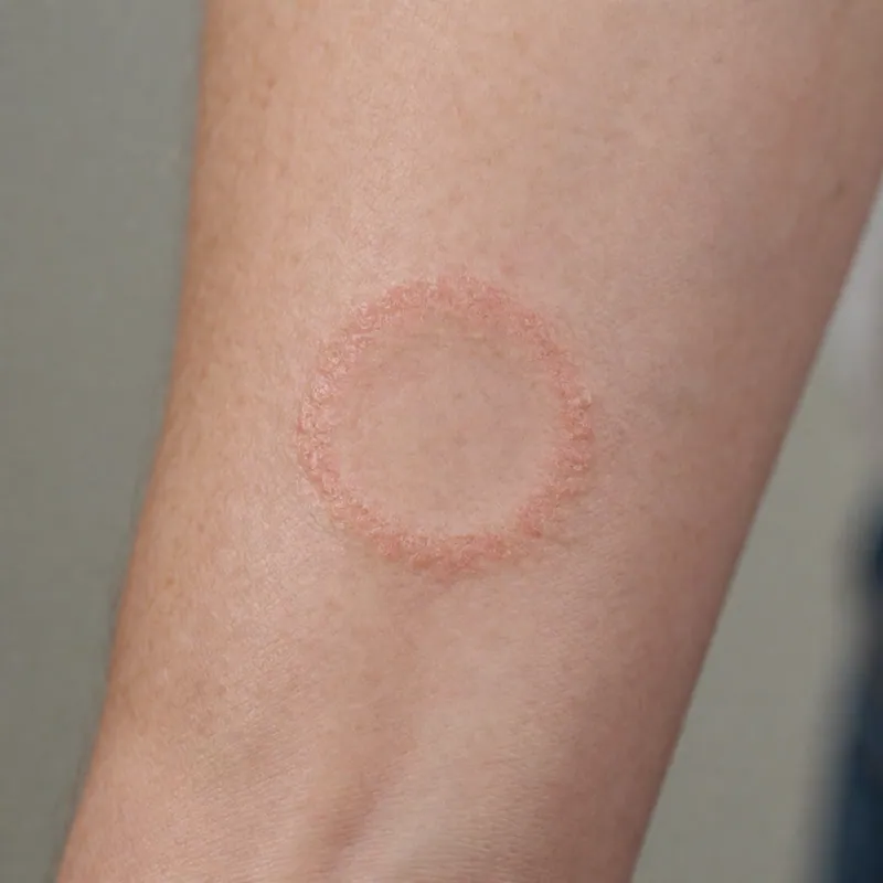 Illustrative image of fungal skin infections — a generated illustration of a typical presentation, not a photograph of a patient